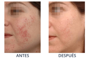 LaserCare® tratamientos para la piel, acné, manchas, remoción tatuajes, líneas de expresión, depilación laser