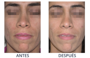 LaserCare® tratamientos para la piel, acné, manchas, remoción tatuajes, líneas de expresión, depilación laser