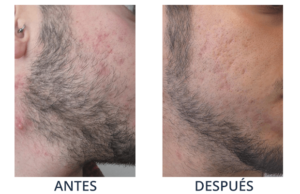 LaserCare® tratamientos para la piel, acné, manchas, remoción tatuajes, líneas de expresión, depilación laser