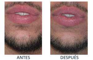 LaserCare® tratamientos para la piel, acné, manchas, remoción tatuajes, líneas de expresión, depilación laser