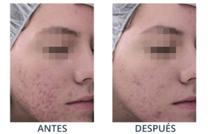 LaserCare® tratamientos para la piel, acné, manchas, remoción tatuajes, líneas de expresión, depilación laser