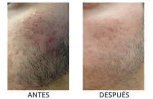 LaserCare® tratamientos para la piel, acné, manchas, remoción tatuajes, líneas de expresión, depilación laser