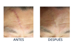 LaserCare® tratamientos para la piel, acné, manchas, remoción tatuajes, líneas de expresión, depilación laser