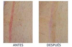 LaserCare® tratamientos para la piel, acné, manchas, remoción tatuajes, líneas de expresión, depilación laser