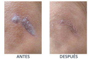 LaserCare® tratamientos para la piel, acné, manchas, remoción tatuajes, líneas de expresión, depilación laser