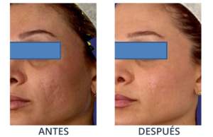 LaserCare® tratamientos para la piel, acné, manchas, remoción tatuajes, líneas de expresión, depilación laser