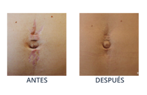 LaserCare® tratamientos para la piel, acné, manchas, remoción tatuajes, líneas de expresión, depilación laser