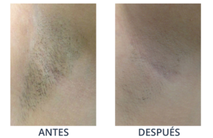 LaserCare® tratamientos para la piel, acné, manchas, remoción tatuajes, líneas de expresión, depilación laser