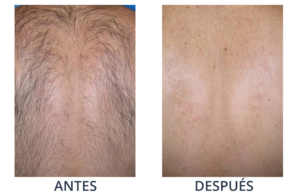 LaserCare® tratamientos para la piel, acné, manchas, remoción tatuajes, líneas de expresión, depilación laser