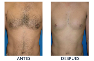 LaserCare® tratamientos para la piel, acné, manchas, remoción tatuajes, líneas de expresión, depilación laser