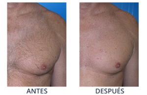 LaserCare® tratamientos para la piel, acné, manchas, remoción tatuajes, líneas de expresión, depilación laser