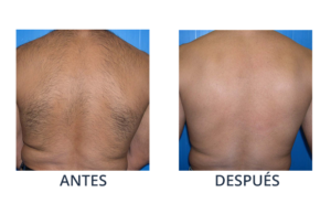 LaserCare® tratamientos para la piel, acné, manchas, remoción tatuajes, líneas de expresión, depilación laser