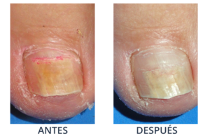 LaserCare® tratamientos para la piel, acné, manchas, remoción tatuajes, líneas de expresión, depilación laser