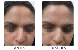 LaserCare® tratamientos para la piel, acné, manchas, remoción tatuajes, líneas de expresión, depilación laser