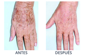 LaserCare® tratamientos para la piel, acné, manchas, remoción tatuajes, líneas de expresión, depilación laser