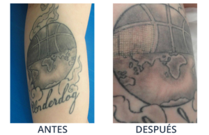 LaserCare® tratamientos para la piel, acné, manchas, remoción tatuajes, líneas de expresión, depilación laser