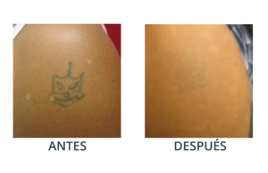 LaserCare® tratamientos para la piel, acné, manchas, remoción tatuajes, líneas de expresión, depilación laser