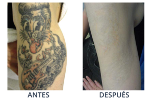 LaserCare® tratamientos para la piel, acné, manchas, remoción tatuajes, líneas de expresión, depilación laser