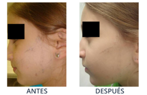 LaserCare® tratamientos para la piel, acné, manchas, remoción tatuajes, líneas de expresión, depilación laser