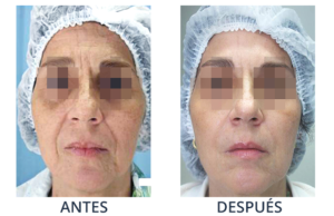 LaserCare® tratamientos para la piel, acné, manchas, remoción tatuajes, líneas de expresión, depilación laser