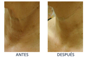 LaserCare® tratamientos para la piel, acné, manchas, remoción tatuajes, líneas de expresión, depilación laser