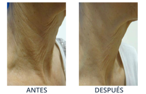 LaserCare® tratamientos para la piel, acné, manchas, remoción tatuajes, líneas de expresión, depilación laser