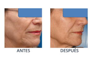 LaserCare® tratamientos para la piel, acné, manchas, remoción tatuajes, líneas de expresión, depilación laser