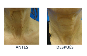 LaserCare® tratamientos para la piel, acné, manchas, remoción tatuajes, líneas de expresión, depilación laser