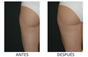 LaserCare® tratamientos para la piel, acné, manchas, remoción tatuajes, líneas de expresión, depilación laser