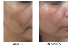 LaserCare® tratamientos para la piel, acné, manchas, remoción tatuajes, líneas de expresión, depilación laser