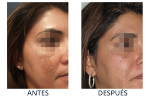 LaserCare® tratamientos para la piel, acné, manchas, remoción tatuajes, líneas de expresión, depilación laser