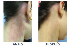 LaserCare® tratamientos para la piel, acné, manchas, remoción tatuajes, líneas de expresión, depilación laser