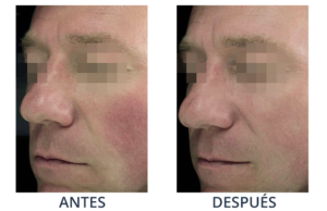 LaserCare® tratamientos para la piel, acné, manchas, remoción tatuajes, líneas de expresión, depilación laser