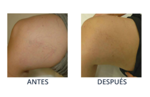 LaserCare® tratamientos para la piel, acné, manchas, remoción tatuajes, líneas de expresión, depilación laser